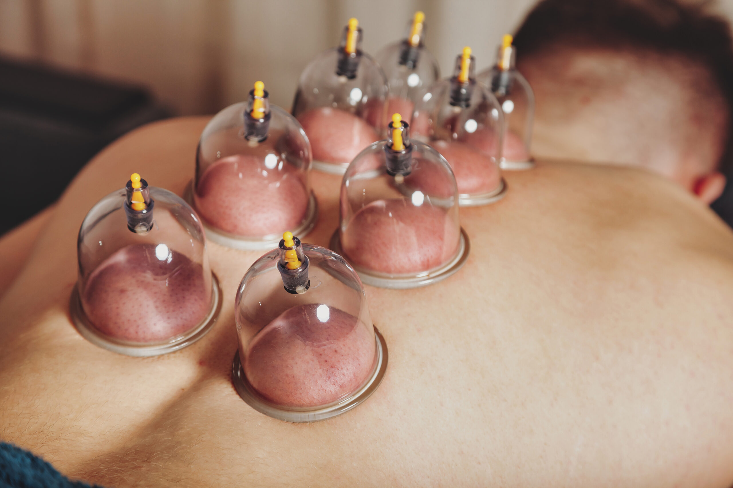 The best cupping therapy also know as cupping massage in malaysia.
